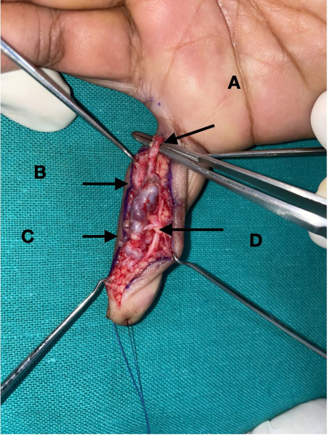 True Digital Artery Aneurysm - A Clinical Vignette.