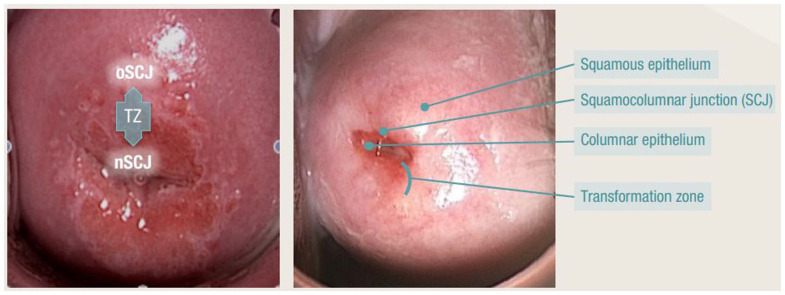 Cervical Transformation Zone Segmentation and Classification based on Improved Inception-ResNet-V2 Using Colposcopy Images.