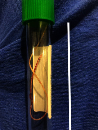 Rare Image of Epidural Catheter Fracture in Lumbar Analgesia.