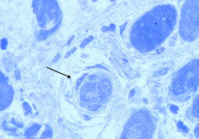 Does Surgical Resection of Horizontal Extraocular Muscles Disrupt Ocular Proprioceptors?