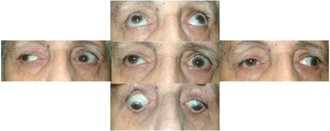 Ocular Myasthenia Gravis: A Current Overview.