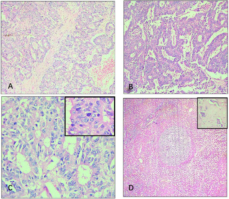 Cystic presentation of primary hepatic neuroendocrine tumour: a case report with a brief review of literature.