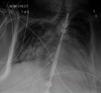 Successful Treatment of Respiratory Failure in a Patient with Prader-Willi Syndrome with Noninvasive Ventilation with AVAPS.