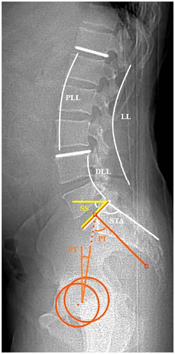 Revealing the Effect of Spinopelvic Alignment on Hip Disorders.