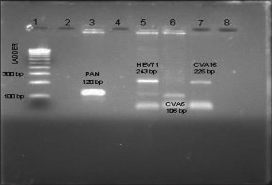 Clinico Virological Characterization of Hand, Foot and Mouth Disease in a Tertiary Care Hospital, South India.