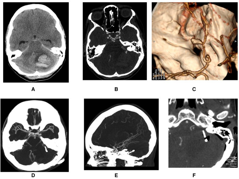 Anterior inferior cerebellar artery (AICA) aneurysms: a radiological study of 15 consecutive patients.