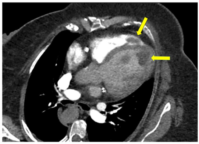 Massive Biventricular Thrombi in a Patient with Endometrial Adenocarcinoma Diagnosed on Computed Tomography Angiography.