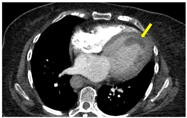 Massive Biventricular Thrombi in a Patient with Endometrial Adenocarcinoma Diagnosed on Computed Tomography Angiography.