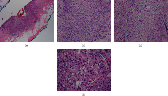 Cutaneous Squamous Cell Carcinoma with Signet-Ring Cell Component and CDX2 Expression in a Patient Treated with PD-1 Inhibitor: A Case Report of a Common Tumor with Unusual Differentiation.