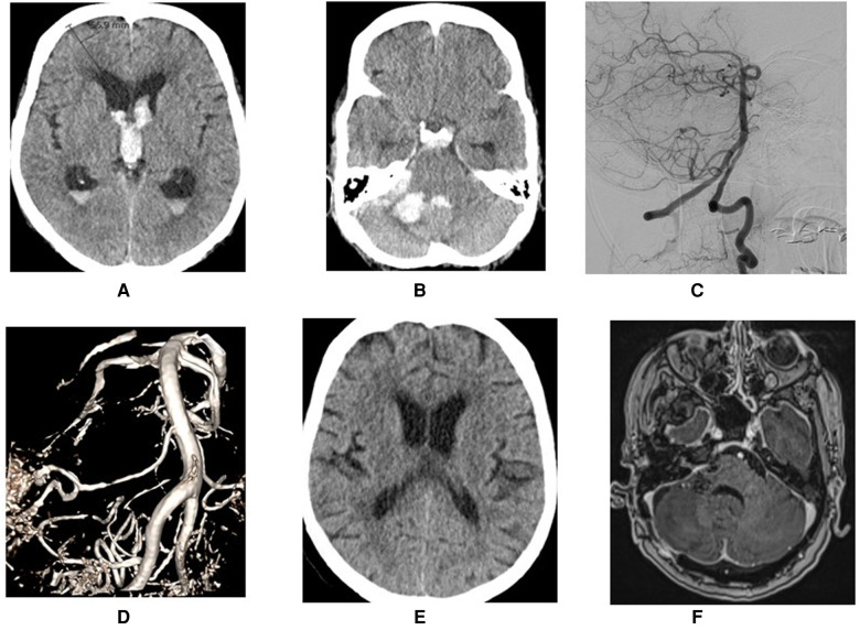 Anterior inferior cerebellar artery (AICA) aneurysms: a radiological study of 15 consecutive patients.