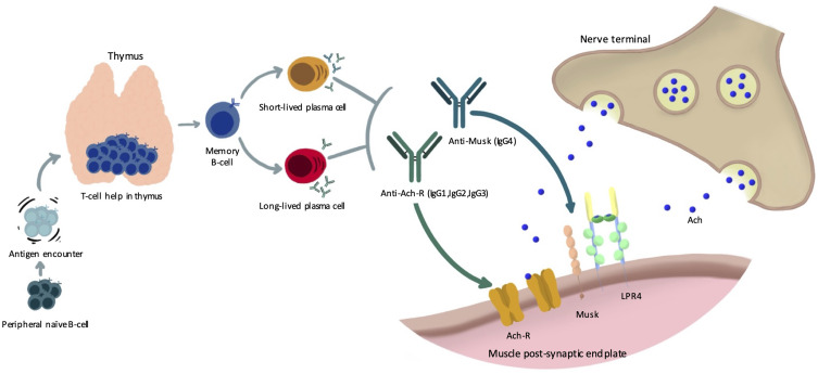 Ocular Myasthenia Gravis: A Current Overview.