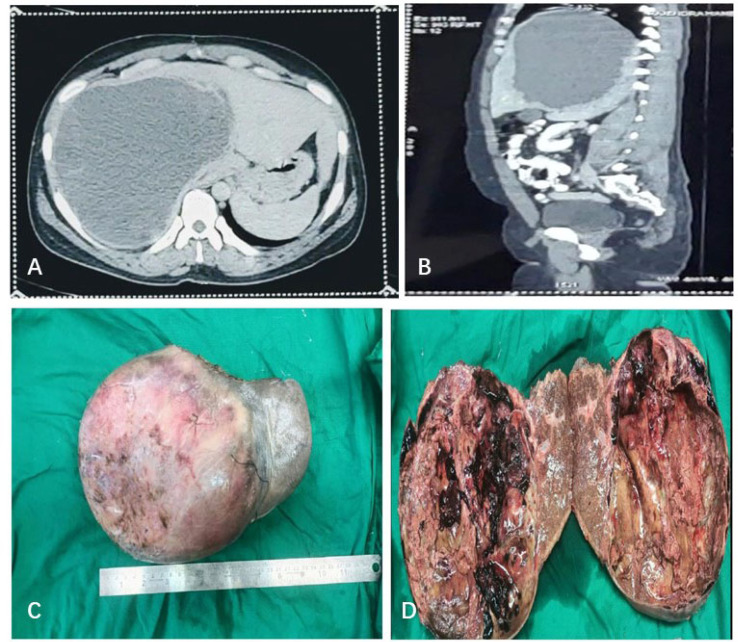 Cystic presentation of primary hepatic neuroendocrine tumour: a case report with a brief review of literature.