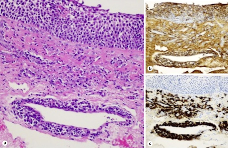 IgG4-Related Esophageal Disease Presenting as Esophagitis with Chronic Strictures.