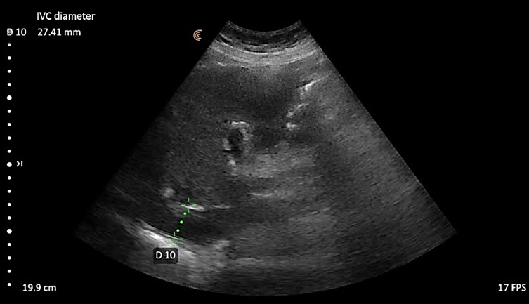 Lung Ultrasound and Caval Indices to Assess Volume Status in Maintenance Hemodialysis Patients.