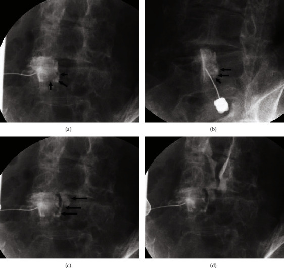 Efficacy of Percutaneous Image-Guided Rupture of Lumbar Facet Cysts: A Retrospective Study.