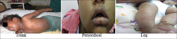 Clinico Virological Characterization of Hand, Foot and Mouth Disease in a Tertiary Care Hospital, South India.