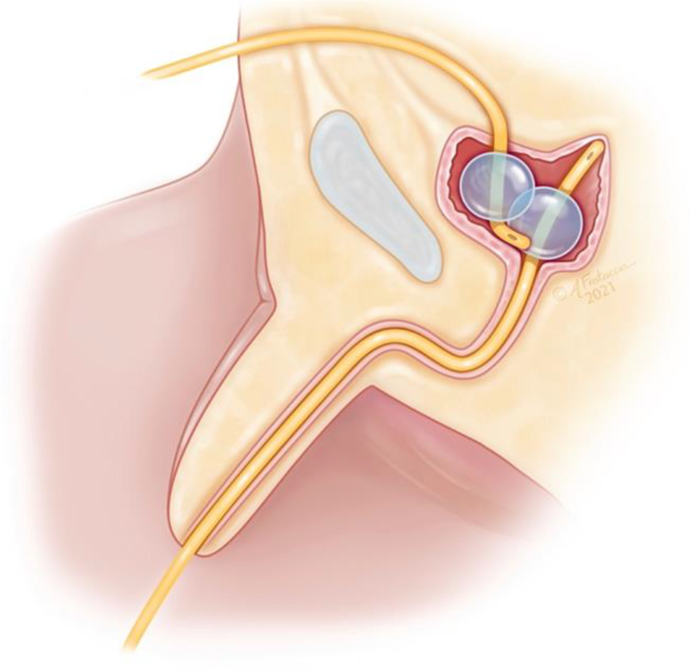 Simultaneous Bladder Drainage via Suprapubic and Urethral Catheters: Which Drains More Completely and Why?