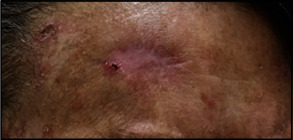 Cutaneous Squamous Cell Carcinoma with Signet-Ring Cell Component and CDX2 Expression in a Patient Treated with PD-1 Inhibitor: A Case Report of a Common Tumor with Unusual Differentiation.