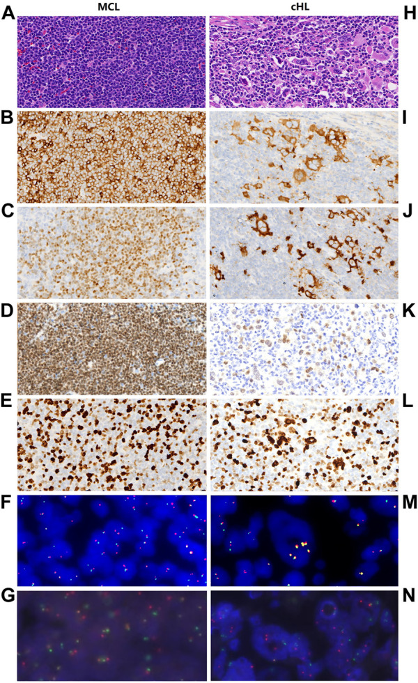 Case report: Composite mantle cell lymphoma and classical Hodgkin lymphoma.