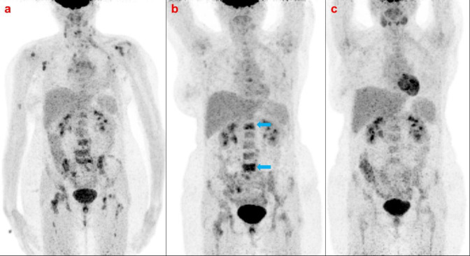 Metabolic flare phenomenon mimicking disease progression on <sup>18</sup>Flouride- Fluorodeoxyglucose PET/CT scan in breast cancer treated with paclitaxel-based chemotherapy.