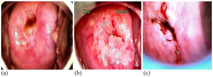 Cervical Transformation Zone Segmentation and Classification based on Improved Inception-ResNet-V2 Using Colposcopy Images.