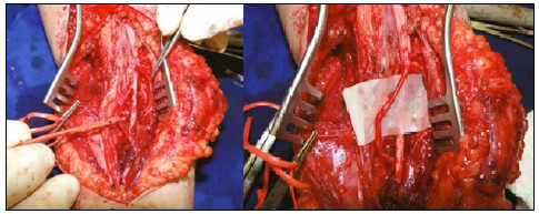 DISTAL NEUROTIZATION OF THE ANTERIOR INTEROSSEOUS NERVE TO RECOVER HAND GRASPING.