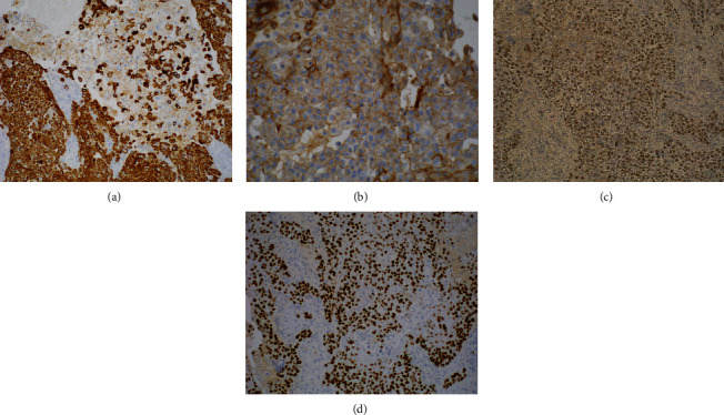 Cutaneous Squamous Cell Carcinoma with Signet-Ring Cell Component and CDX2 Expression in a Patient Treated with PD-1 Inhibitor: A Case Report of a Common Tumor with Unusual Differentiation.