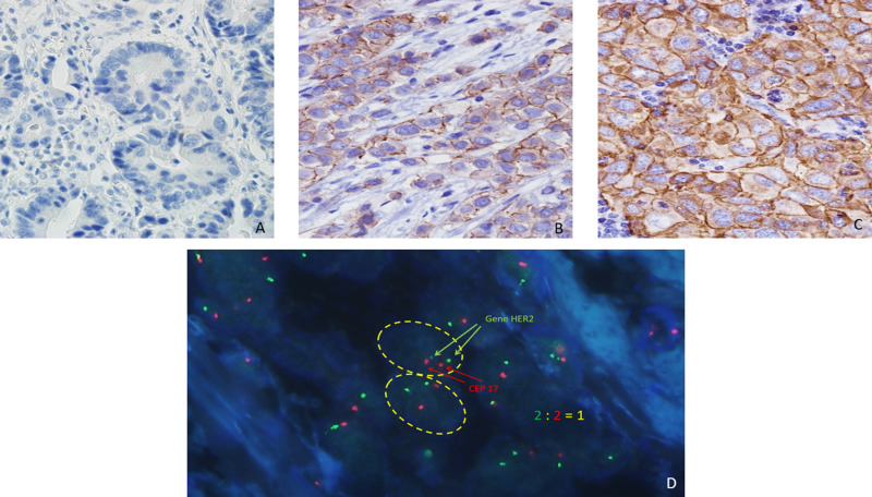 Exploring Real-World HER2-Low Data in Early-Stage Triple-Negative Breast Cancer: Insights and Implications.