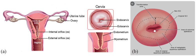 Cervical Transformation Zone Segmentation and Classification based on Improved Inception-ResNet-V2 Using Colposcopy Images.