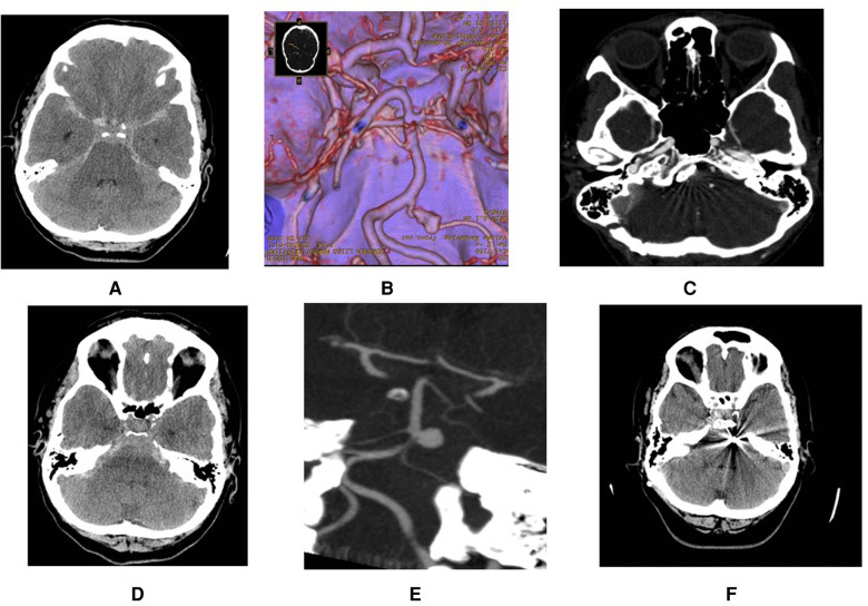 Anterior inferior cerebellar artery (AICA) aneurysms: a radiological study of 15 consecutive patients.