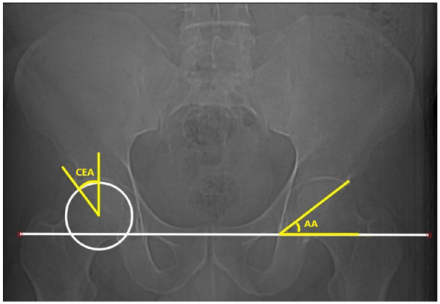 Revealing the Effect of Spinopelvic Alignment on Hip Disorders.