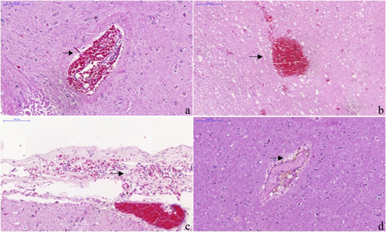 Neuropathology of yellow fever autopsy cases.