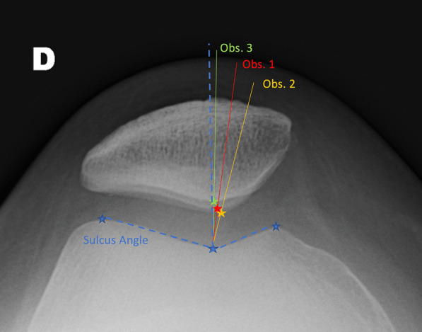 Radiographic measurement of the congruence angle according to Merchant: validity, reproducibility, and limits.