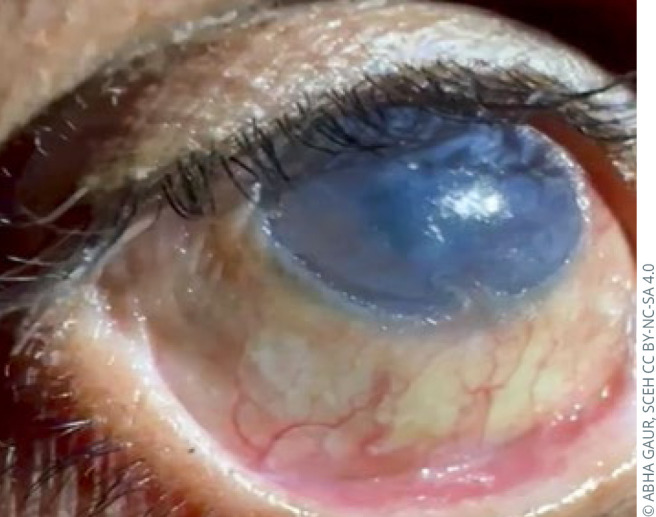 The impact of oral and systemic medications on the eye.