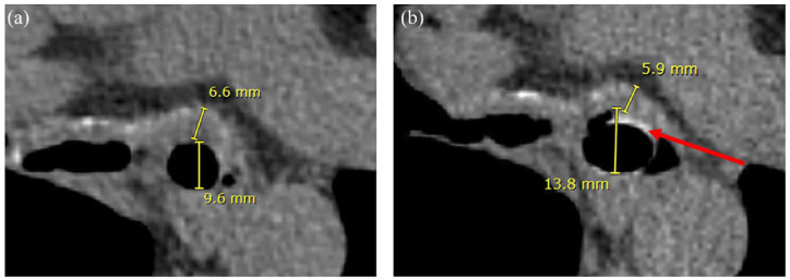 Determination of patient-specific airway stent fit using novel 3D reconstruction measurement techniques: a 4-year follow-up of a patient.