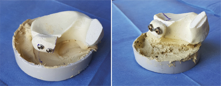 FIXATION METHODS IN LATARJET: BIOMECHANICAL COMPARISON OF SCREW TYPES AND PLATE FIXATION.