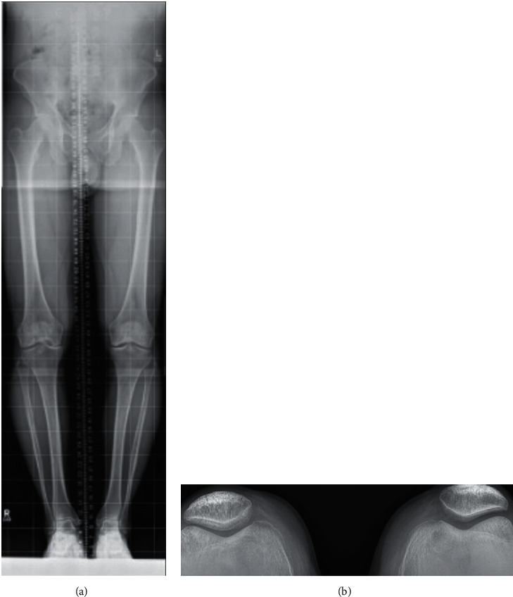 MACI "Sandwich" Technique for a Large Osteochondritis Dissecans Lesion: A Case Report.