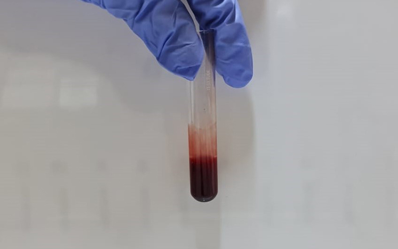 Comparing modified Lee and White method against 20-minute whole blood clotting test as bedside coagulation screening test in snake envenomation victims.