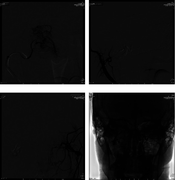 Case of IV Stage Juvenile Nasopharyngeal Angiofibroma Presurgically Treated with a Single ECA Stop-Flow Embolization Technique Using Onyx 18.