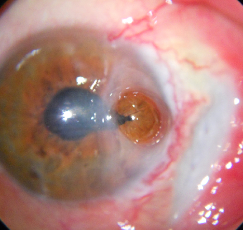 Retrocorneal Scleral Patch Supported Glue: A Technique for Management of Corneal Perforation and Corneoscleral Melt following Pterygium Surgery.