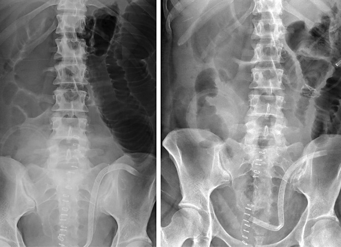 Early Onset Outlet Obstruction of a Temporary Diverting Loop Ileostomy Secondary to Urinary Retention.