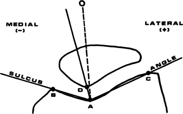 Radiographic measurement of the congruence angle according to Merchant: validity, reproducibility, and limits.