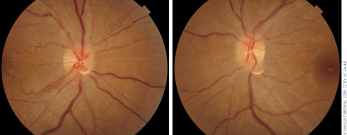 The impact of oral and systemic medications on the eye.