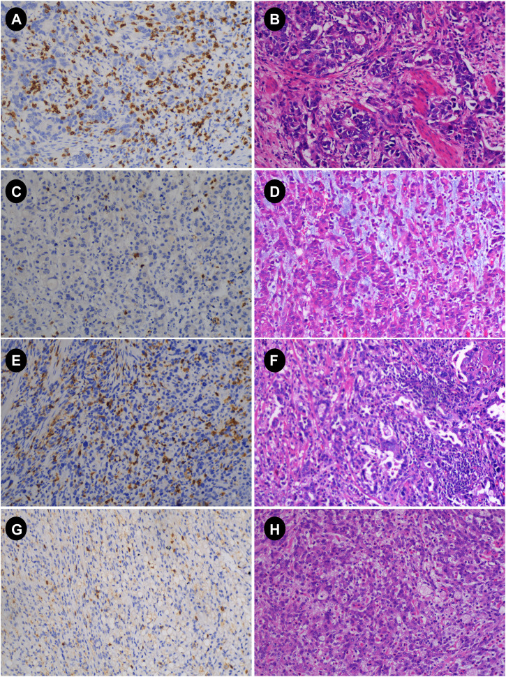 Association between radiomics features of DCE-MRI and CD8<sup>+</sup> and CD4<sup>+</sup> TILs in advanced gastric cancer.