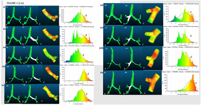 Determination of patient-specific airway stent fit using novel 3D reconstruction measurement techniques: a 4-year follow-up of a patient.