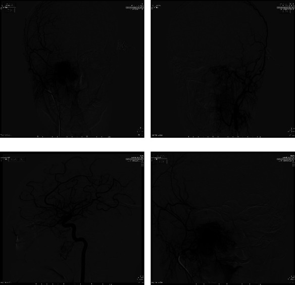 Case of IV Stage Juvenile Nasopharyngeal Angiofibroma Presurgically Treated with a Single ECA Stop-Flow Embolization Technique Using Onyx 18.