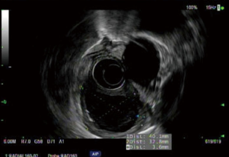 Esophageal duplication cysts: a clinical practice review.