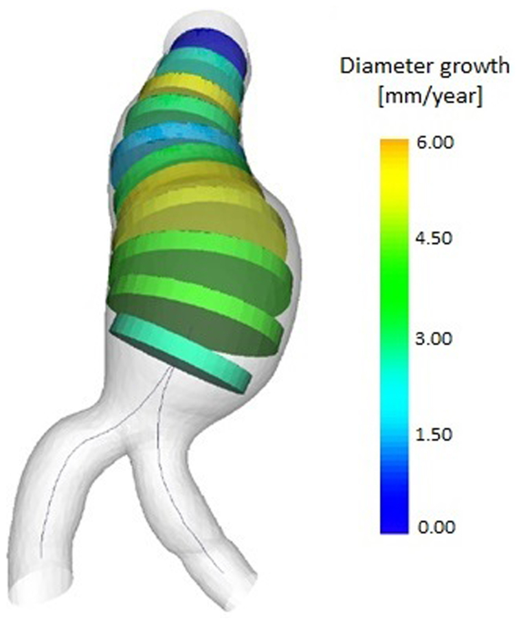 AI-powered assessment of biomarkers for growth prediction of abdominal aortic aneurysms