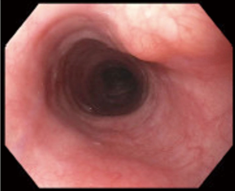 Esophageal duplication cysts: a clinical practice review.