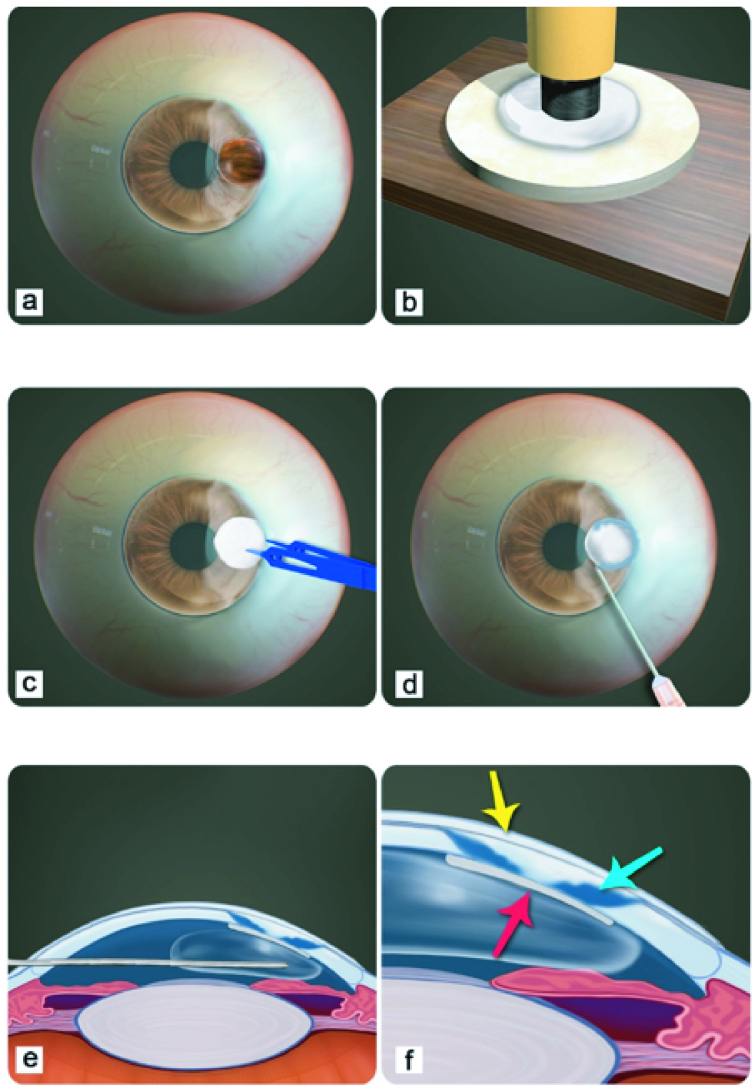 Retrocorneal Scleral Patch Supported Glue: A Technique for Management of Corneal Perforation and Corneoscleral Melt following Pterygium Surgery.